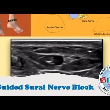 US Guided Sural Nerve Block of the Ankle