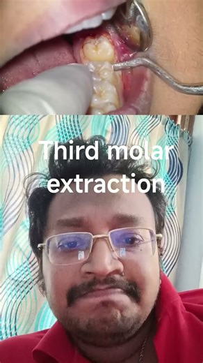 Third molar extraction..... wisdom teeth extraction #dentist #dentistry #extraction#