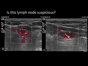 Ultrasound of cervical lymph nodes technique & evaluation criteria (Gerasimos Sykiotis)