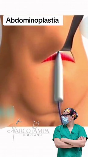 Abdominoplastia #abdominoplastia #abdominoplasty #lipo #liposuccion #bajardepeso #bajardepesorapido #tummytummy #viral #tiktok #parati