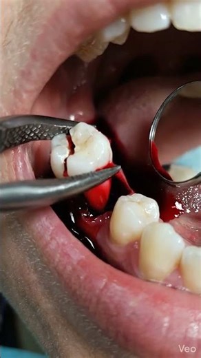 The most difficult broken tooth extraction 😬 the result was surprising!