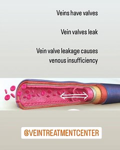 Veins have valves. Vein valve leakage causes venous insufficiency. Venous insufficiency causes aching and leg pain, leg cramping and throbbing, swelling of the legs, ankles and feet. Call 716-839-3638 if you have these symptoms. | Vein Treatment Center | Facebook