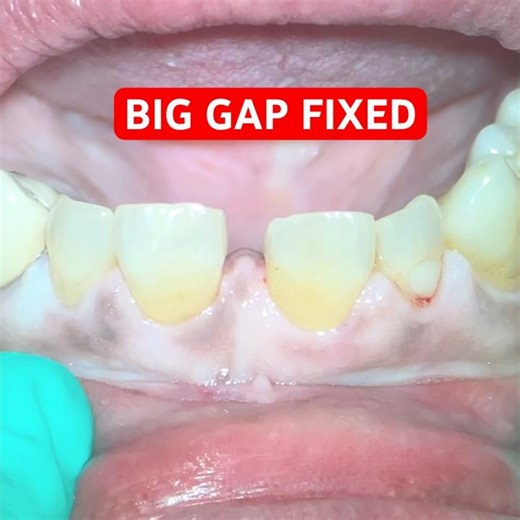 Massive Diastema Transformation 😳➡️ Perfect Smile (Temp Crowns)