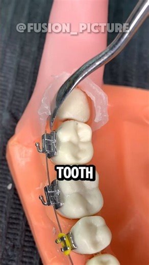 how dentists remove a tooth 😳 !