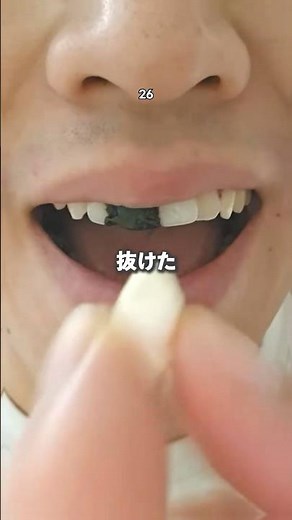 突然歯が抜けた時の対処方法は！？