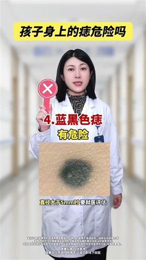 孩子身上的痣哪些有癌变风险？一条视频教你快速自查！ #医学科普 #痣 #癌变痣 #科普 #宝妈必看