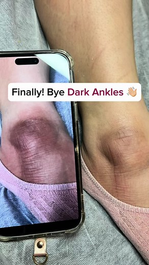 Melanin Whitening Treatment for Dark Ankles | Immediate Results
