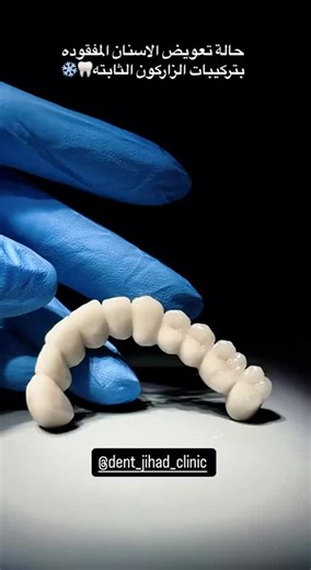 Dental Prosthesis Placement Procedure Explained