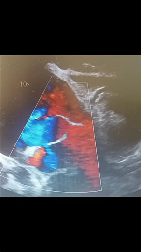 ASD with bidirectional shunt mainly from right to left. https://youtube.com/@zubairaliechocardiographer?si=wYLAAIKqQ03lU5gS | Learn Echocardiography with Zubair Ali