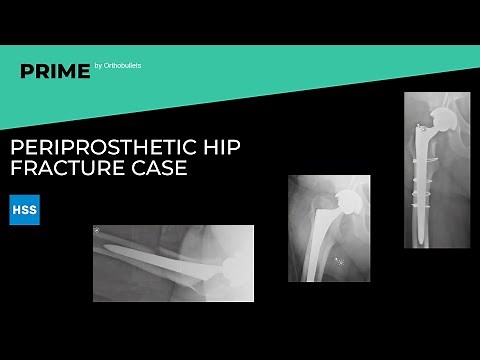 Periprosthetic Hip Fracture Case - Steven J. MacDonald, MD, FRCSC