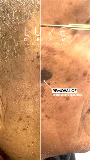 At Luxe Derm, we offer safe and doctor-performed removal of seborrheic keratosis using: ✔️ Electrocautery ✔️ Laser removal Our licensed doctor will assess your skin first to ensure the right treatment, minimal downtime, and smooth healing. Book your Seborrheic Keratosis removal at Luxe Derm. #LuxeDermSkinClinic #LuxuryYouCanAfford | Luxe Derm Skin Care Clinic