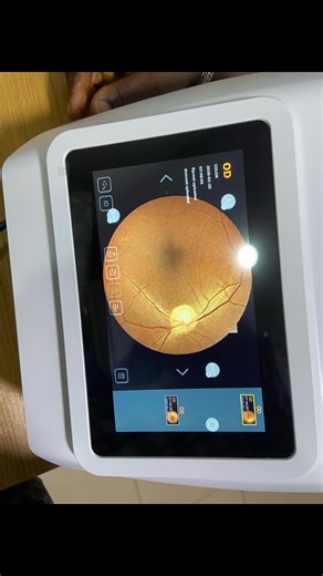 Wexvue Kestrel 300 Portable Fundus Camera Bring retinal imaging to your clinic, outreach, or bedside with confidence. ✔️ High-resolution retinal images ✔️ Fully portable & lightweight ✔️ Non-mydriatic imaging (comfortable for patients) ✔️ Fast capture, easy operation ✔️ Ideal for clinics, hospitals & eye camps From early detection to routine screening, the Kestrel 300 delivers clear, reliable fundus images—wherever care is needed. 📍 Perfect for ophthalmologists, optometrists & eye care professi