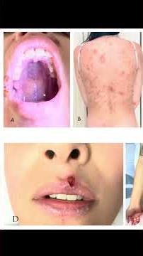 Secondary Syphilis: Visual Guide to Palmoplantar Rashes #MedEd #SyphilisRash #realpatientcase