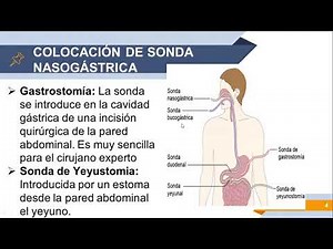 COLOCACIÓN DE SONDA NASOGÁSTRICA, NUTRICIÓN ENTERAL Y LAVADO GÁSTRICO.