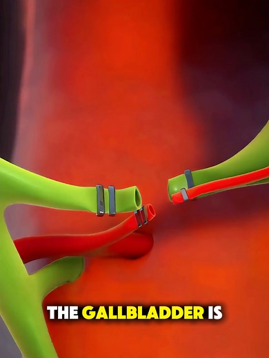 Gallbladder Removal Surgery Explained with 3D Animation