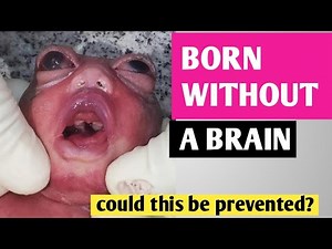 Why Some BABIES Are Born Without a BRAIN ( Anencephaley)