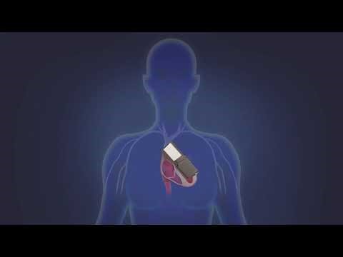 World's Smallest Pacemaker VS Conventional Pacemaker