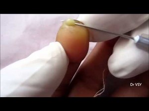 Abscess At Finger Tip