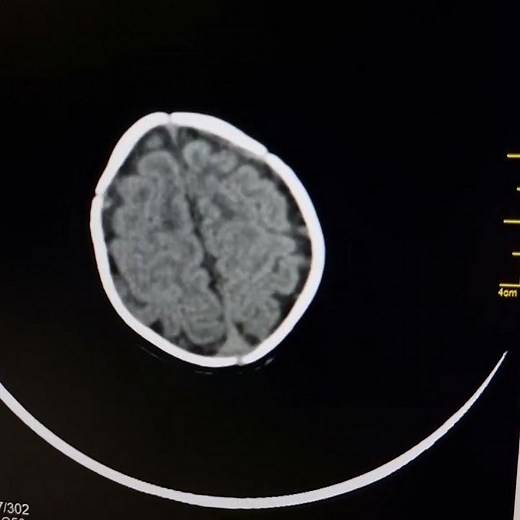 Mild cerebral atrophy +Leukodystrophy