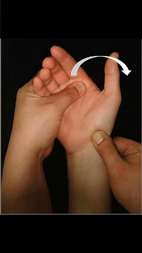 Scapholunate Instability Explained 🦴 #radiology #meded #meded #physio #atc #orthopedic