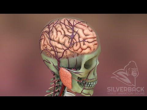 Brain Aneurysm Overview Animation