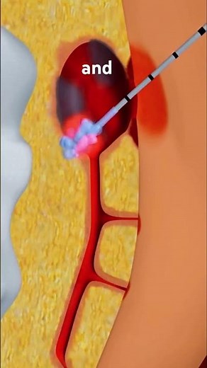 What’s Inside A Pilonidal Cyst #3danimation