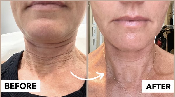 Salmon DNA Treatment for Neck Rejuvenation!