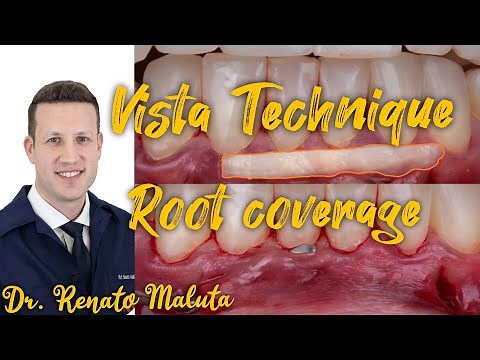 Vista Technique. Root coverage. Periodontal treatment. Dr. Renato Maluta
