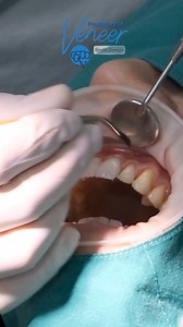 Beautiful veneer procedure results performed by the team at Bangkok Smile Clinic. 朗  Message us for a free online consultation! 醴 Learn more at https://www.dentaldepartures.com/dentist/bangkok-smile-dr-paulo-malo-global-network-sukhumvit-soi-5 #dentaldepartures #dentaltourism | Dental Departures | Facebook