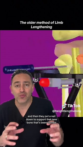 Internal Limb Lengthening Techniques Explained