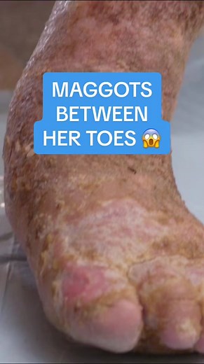 This woman found maggots in between her toes 😱 Trust us, this is a case you don't want to miss. #DrPimplePopper is Wednesdays at 9/8c.
