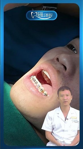 Revealing the Process of Placing Orthodontic Archwires | Doctor Yen