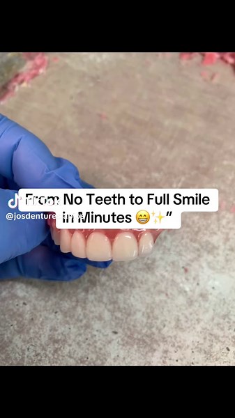 From No Teeth to Full Smile in Minutes 😁✨”Watch the amazing journey from no teeth to a complete, natural-looking smile in just minutes. Every step in the denture process is carefully crafted to bring back confidence, comfort, and happiness. Smiles truly change lives — and this transformation shows why! Hashtags (5): #DentureTransformation #SmileGoals #NewSmile #DentalCare #ConfidenceBoost