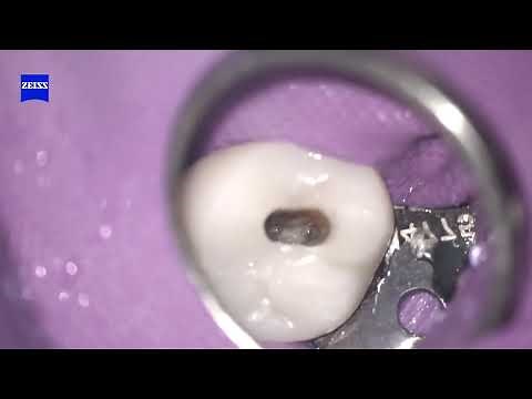 Maxillary first molar endodontic treatment steps- access preparation, instrumentation and obturation