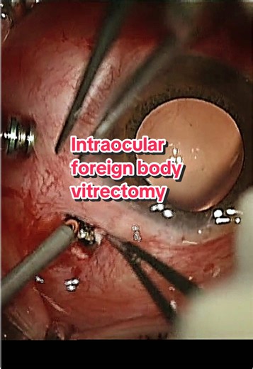 Understanding Metallic Intraocular Foreign Body Vitrectomy