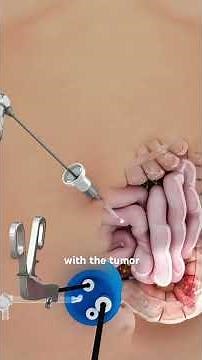 Colorectal Cancer Surgery Explained (3D Animation) #cancer #surgery #colon #recovery #3danimation