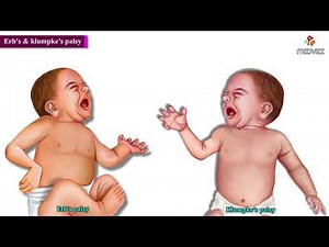 Erb's Palsy and Klumpke's Palsy (Animated Video)