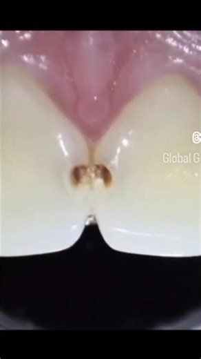 Smile Transformation | Front Teeth Cavity Restoration #dentist #dentista