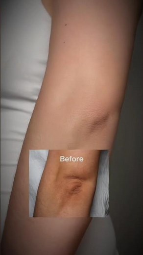 Dark Elbows Fixed | How Retinal + Routine Changed My Skin! #shorts #skincare #darkelbows #retinal