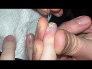Popping huge blackheads and Pimple Popping - Best Pimple Popping Videos 273