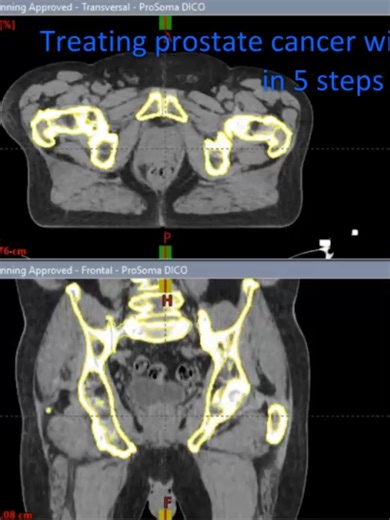 Illustrates how the treatment of #prostate #cancer using #radiotherapy is simulated and delivered. Please watch until the END