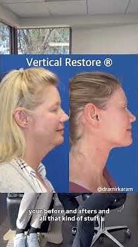 Facelift Results After 30 Pound Weight Loss
