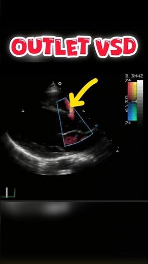 Outlet VSD #heart Echocardiography for beginners # echo #shorts