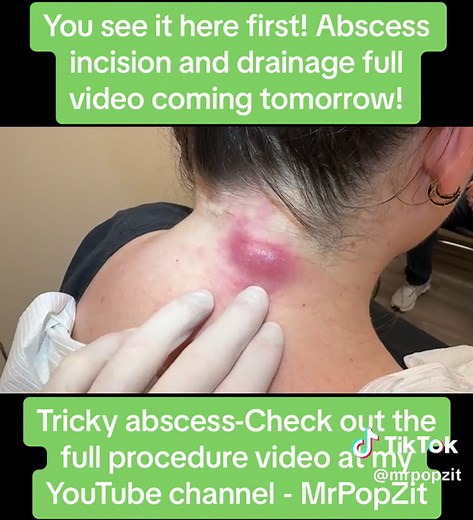 Cyst and Abscess Incision and Drainage Procedure