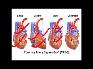 CABG. ( Coronary Artery Bypass Grafting) / Bypass surgery of Heart in details With Explanation 👍👍