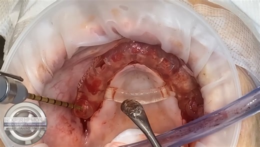 Pterygoid Guide Protocol with Stability Check