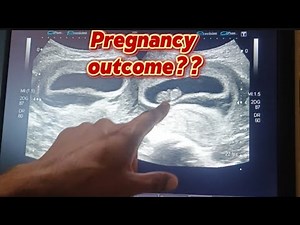 Subchorionic Hematoma (SCH) | 8 Weeks 6 Days Pregnancy Scan