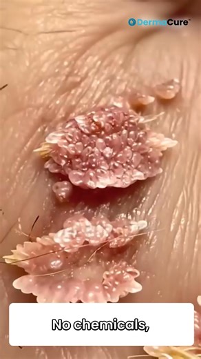 DISCOVERY: Thousands of people are using DermaCure™ to permanently remove warts, spots, and moles — without pain or scarring. Certified dermatologist: “This laser pen removes skin imperfections from the very first use — without pain, without scabs, and without leaving any marks. It stimulates cell renewal for smoother, rejuvenated skin.” One of our customers shares: “I didn’t believe it at first, but the result is amazing! I had brown spots for years and a wart on my cheek. After just one applic