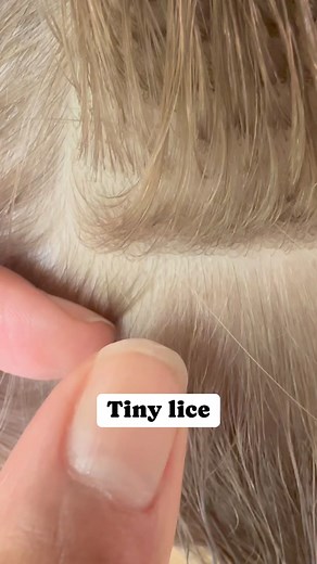 206K views · 251 reactions | Tiny louse l lice removal service #lice #momlife #hair #school #explore #piojos #smallbusiness | Stacey The Louse Lady | Facebook
