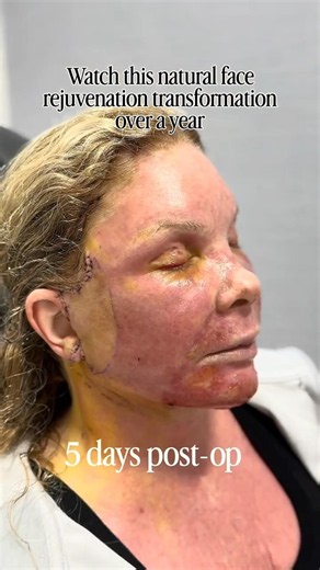 Natural Female Facial Rejuvenation Transformation | 1 Year Post-Op | Bay Area